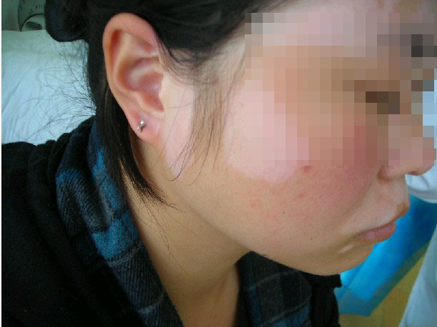 白癜风使用药物能治好吗(图1) 白癜风使用药物能治好吗(图1)