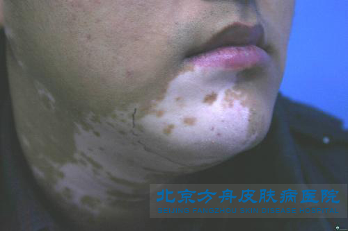 白癜风患者冬季应如何护理呢(图1) 白癜风患者冬季应如何护理呢(图1)