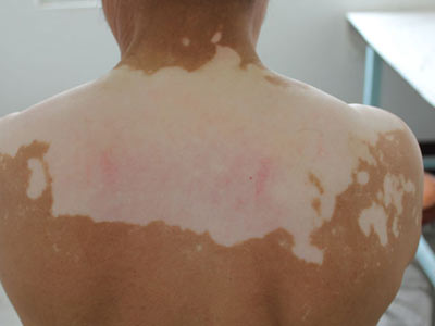 白癜风没有治好是什么原因?(图1) 白癜风没有治好是什么原因?(图1)