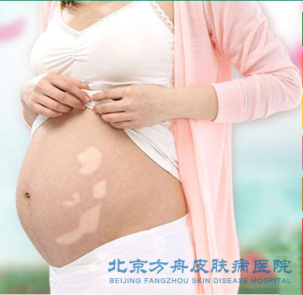孕妇白癜风怎么预防(图1) 孕妇白癜风怎么预防(图1)