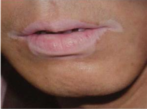 扁桃体炎反复容易引发白癜风?(图1) 扁桃体炎反复容易引发白癜风?(图1)