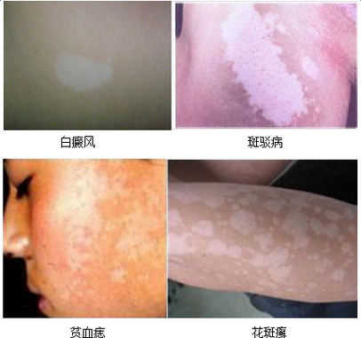 白癜风症状图片 识别白癜风