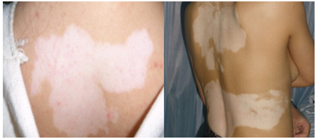 白癜风症状图片 识别白癜风(图2) 白癜风症状图片 识别白癜风(图2)