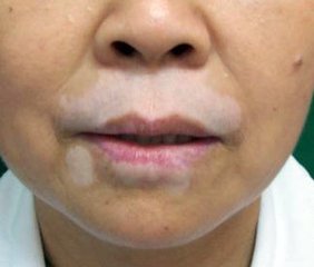 脸上患了白癜风会出现什么症状?(图1)
