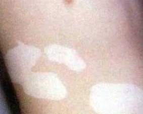在白癜风发病的早期有什么症状?(图1)