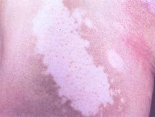 白癜风患处变红脱皮是怎么回事?(图1)
