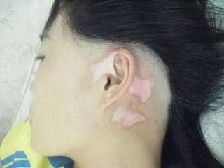 女性白癜风是怎么患上的呢？(图1)