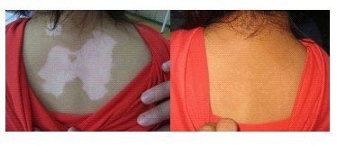 如何预防白癜风的发生?(图1)