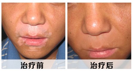 夏季预防白癜风三种方法别错过(图1)