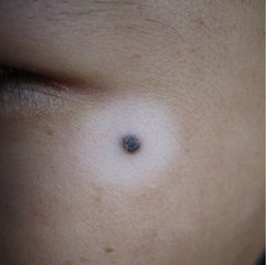 婴儿患白癜风应怎么护理?(图1)