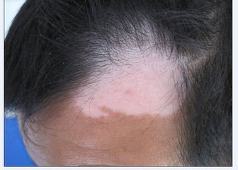 怎样才能更快地治好白癜风?(图1)