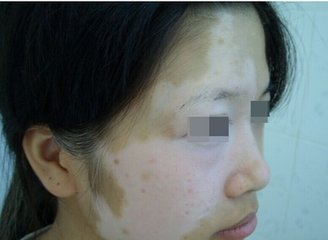 长期熬夜是导致白癜风的发病吗?(图1)