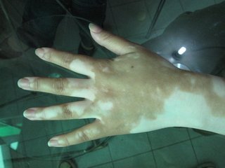 冬季治疗白斑好吗?(图1) 冬季治疗白斑好吗?(图1)