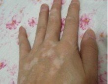 治白癜风得花多少钱?(图1) 治白癜风得花多少钱?(图1)