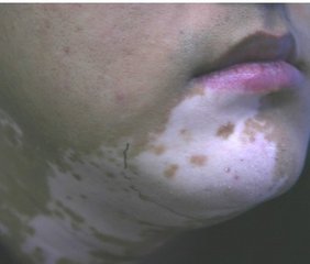 如何治疗节段型白癜风呢?(图1) 如何治疗节段型白癜风呢?(图1)