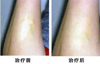 白癜风在饮食方面需要知道哪些呢?(图1) 白癜风在饮食方面需要知道哪些呢?(图1)