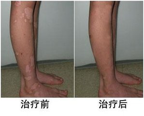 不良的生活习惯,小心白癜风找上你(图1) 不良的生活习惯,小心白癜风找上你(图1)