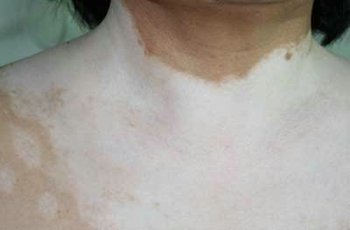 给老年白癜风患者一个安稳的生活(图1) 给老年白癜风患者一个安稳的生活(图1)