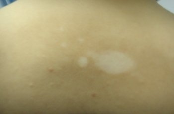 白癜风莫名其妙的出现该怎么办?(图1) 白癜风莫名其妙的出现该怎么办?(图1)