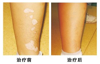 白癜风能够治好吗?(图1) 白癜风能够治好吗?(图1)