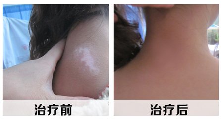 是否患上白癜风?一起看下白癜风的症状!(图1) 是否患上白癜风?一起看下白癜风的症状!(图1)