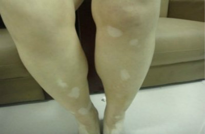 看看还有哪些治疗白癜风又好又快的攻略?(图1) 看看还有哪些治疗白癜风又好又快的攻略?(图1)