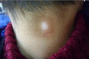 马春林详细讲解白癜风的这些症状!(图1) 马春林详细讲解白癜风的这些症状!(图1)
