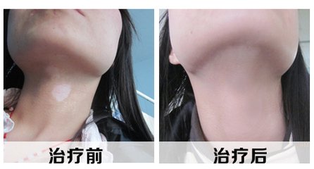 女性白癜风和哪些因素有直接关系?(图1) 女性白癜风和哪些因素有直接关系?(图1)