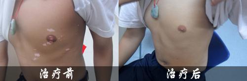 白癜风患者吸烟会怎么样?(图1) 白癜风患者吸烟会怎么样?(图1)
