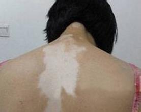 引起白癜风的病因有哪些?(图1) 引起白癜风的病因有哪些?(图1)