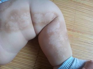 宝宝患上白癜风后怎么办?(图1) 宝宝患上白癜风后怎么办?(图1)