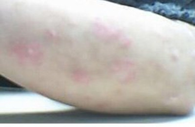 白癜风治疗需要花多少钱?(图1) 白癜风治疗需要花多少钱?(图1)