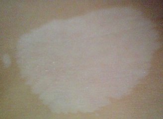 儿童该怎么预防白癜风?(图1) 儿童该怎么预防白癜风?(图1)