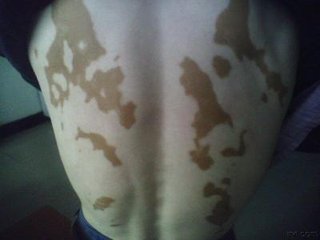 老人为什么容易得白癜风?(图1) 老人为什么容易得白癜风?(图1)