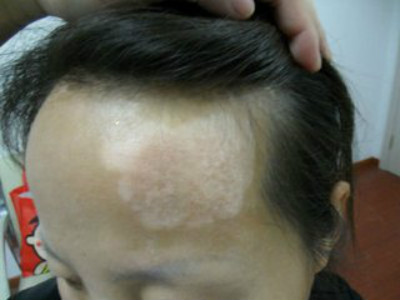 脸上长白癜风的病因?(图1) 脸上长白癜风的病因?(图1)