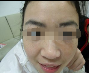 脸上有了白癜风要注意什么?(图1) 脸上有了白癜风要注意什么?(图1)