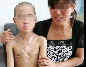 怎么预防儿童白癜风呢?(图1)