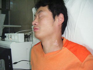 怎样治疗男性白癜风?(图1) 怎样治疗男性白癜风?(图1)