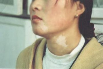 如何正确对待白癜风病情?(图1)