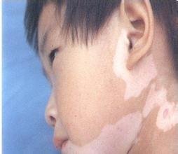 小儿白癜风症状是什么?(图1)