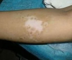 老年人胳膊上的白斑有什么症状?(图1)