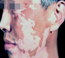 老年人患上白癜风有哪些危害?(图1)