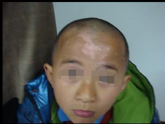 小孩子得了白癜风怎么办才好?(图1)