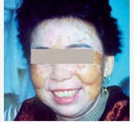 怎么护理老年人的白癜风好?(图1)