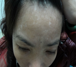 冻伤会不会引发白癜风?(图1)