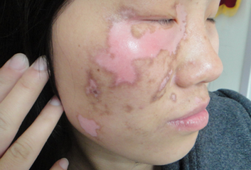 面部白癜风的发病因素有哪些?(图1) 面部白癜风的发病因素有哪些?(图1)