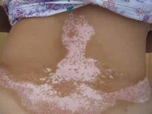 患上白癜风后有哪些症状?(图1)