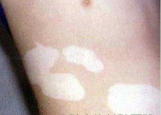 治疗白癜风需要多长时间?(图1) 治疗白癜风需要多长时间?(图1)