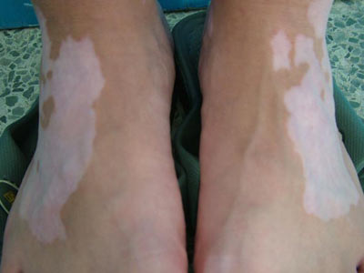 白癜风诱发的因素有哪些