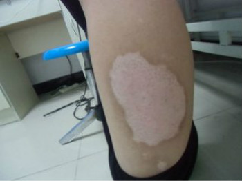 腿上得了白癜风怎么办?(图1) 腿上得了白癜风怎么办?(图1)